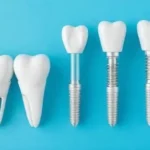 dental implants abroad helvetic clinics